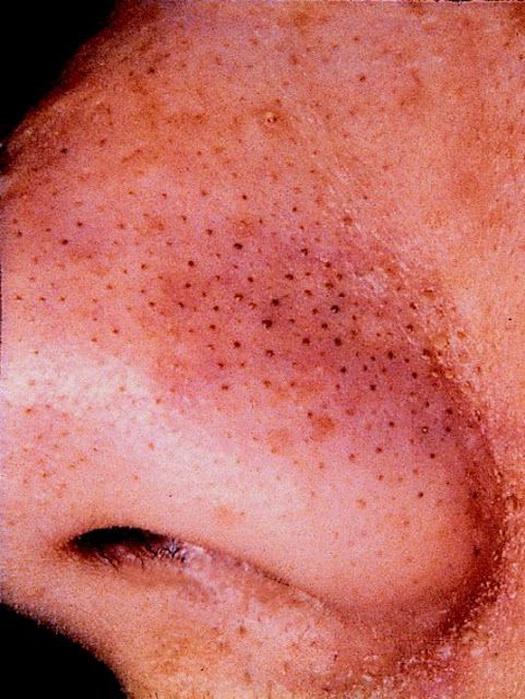 How to Get Rid of Blackheads Easy