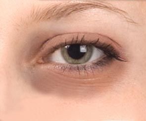 remove dark circles under the eye