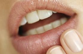 3 Ways to Get Rid of Cold Sores Naturally