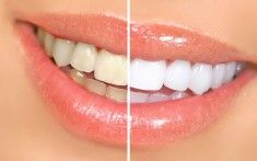 Baking soda and lemon for whiter teeth. This may be one of the most popular of t