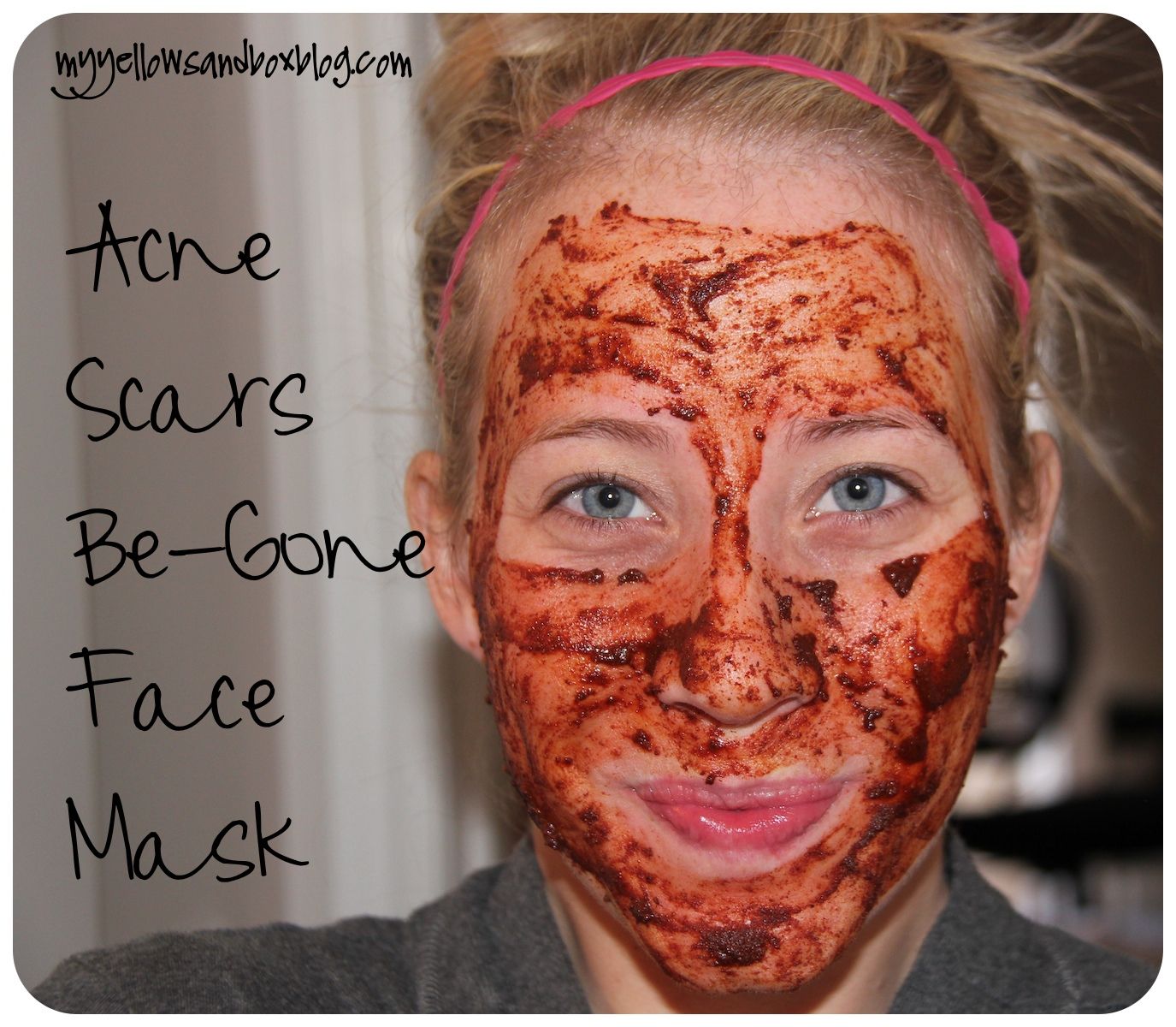 Natural Acne Scar removal mask