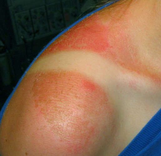 The single most effective way to get rid of a sunburn.. Better pin this to remem