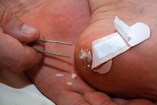 Remove a splinter easily by applying a paste of baking soda and water, then wait