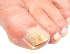 Home remedies for nail fungus