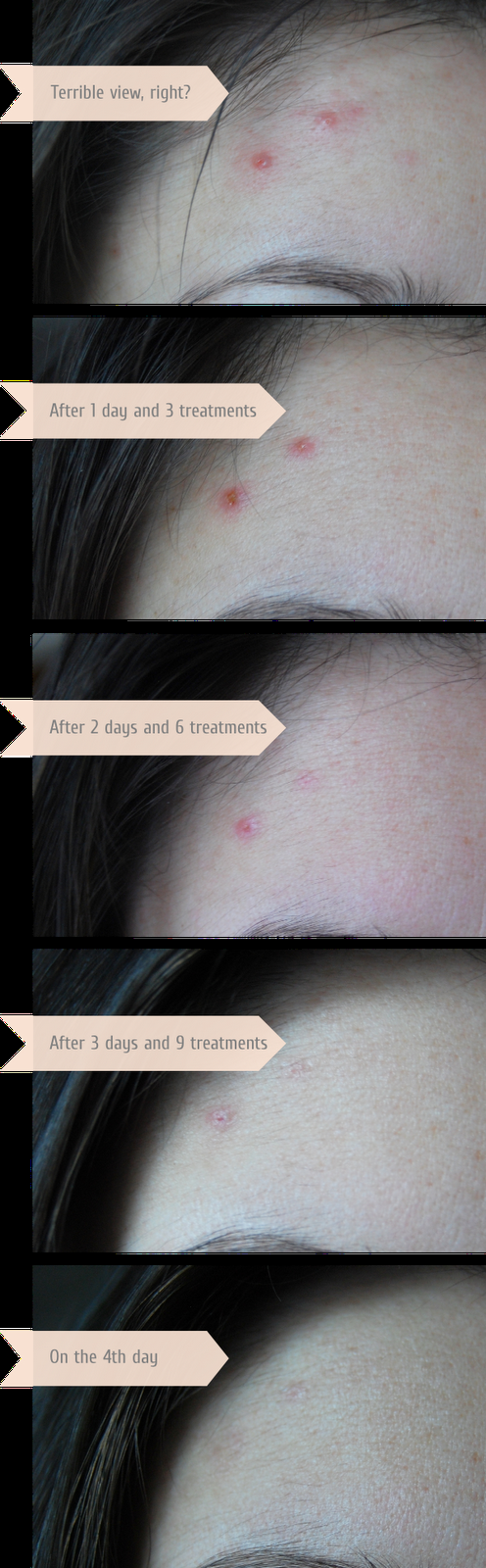 How to treat acne in 4 days with the help of banana peels?