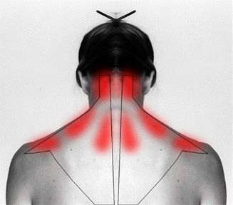 How To Treat  And Cure Stiff Neck Or Shoulder To Ease The Pain. This is amazing!