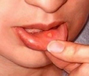 PIN Now USE later… 24 natural ways to get rid of a canker sores :)
