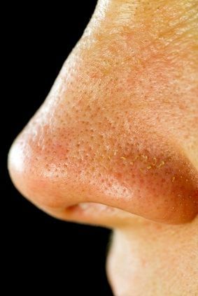 Solutions For Large Pores…What Causes Pores to Enlarge?