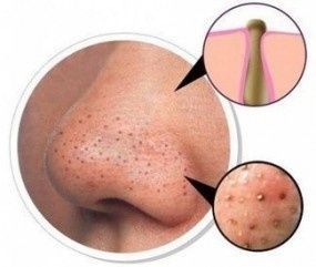 Beauty Club: Getting Rid of Blackheads — s. There is a natural way to remove yo