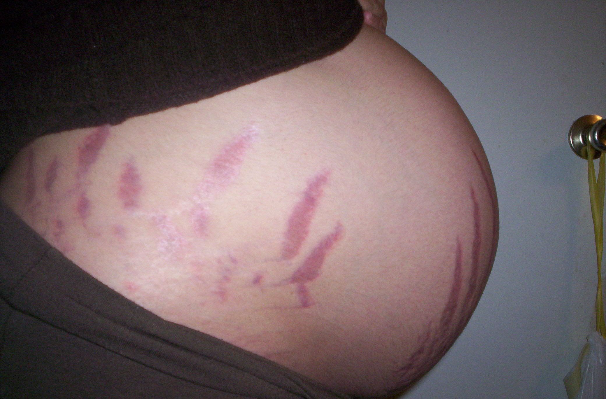 Nobody likes stretch marks, but most people (especially women) will get them at