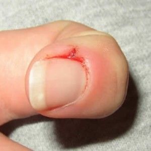 Effective Home Remedies For Hangnails