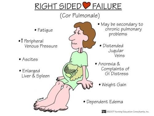 Right-sided heart failure
