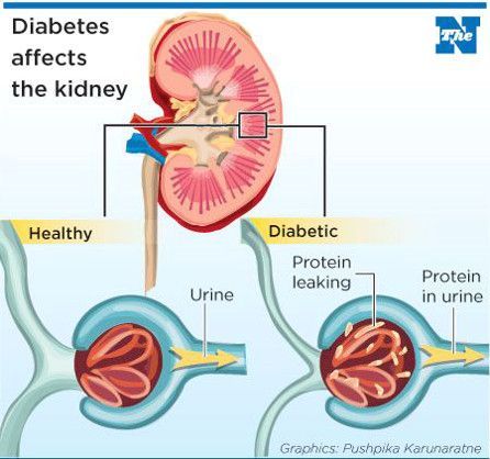 Diabetes affects the kidney