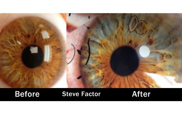 Steve Factor Before After Iridology  How a raw food diet can change your eye