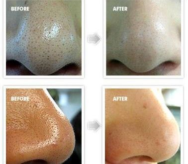 How to get rid of blackhead