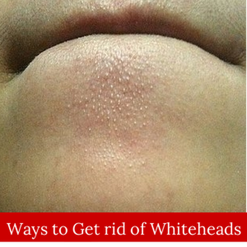 How to Get Rid of Whiteheads | Cute Parents