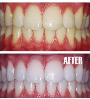 Put a tiny bit of toothpaste into a small cup, mix in one teaspoon baking soda plus one teaspoon of hydrogen peroxide, and half a