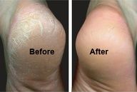 Soften and Get Rid of Tough Calluses: blend two tablespoons of baking soda in a basin of warm water and add a few drops of
