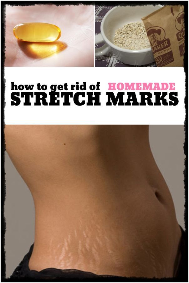 Stretch marks will never be a problem from now on. Read this article to see how you can get rid of stretch marks.