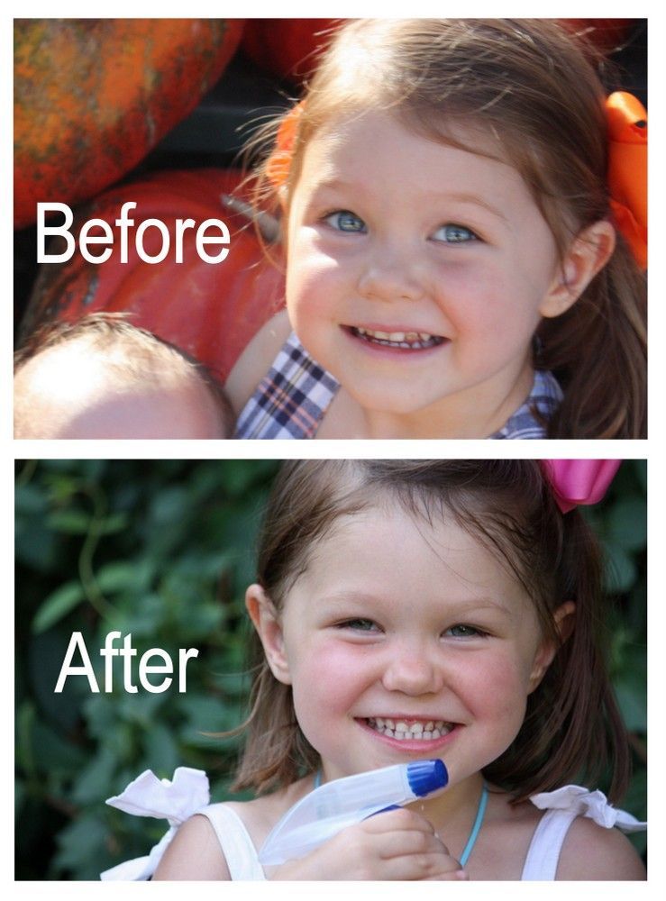 How I Reversed My Daughters Tooth Decay | The Mommypotamus | organic SAHM sharing her family stories and recipes
