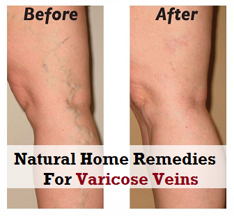 Natural Home Remedies For Varicose Veins