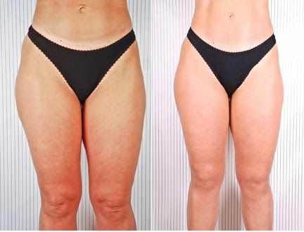 How to Get Rid of Inner Thigh Fat-Top 3 Tips