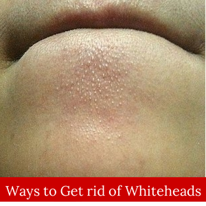 How to Get Rid of Whiteheads | Cute Parents @Shila Morath
