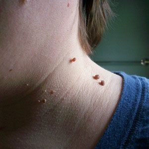 HOME REMEDIES FOR SKIN TAGS-interesting.. will have to remember if I ever get one.