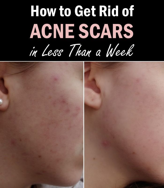How to Get Rid of Acne Scars in Less Than a Week #AcneScars