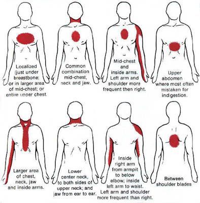 Signs of heart attack in women
