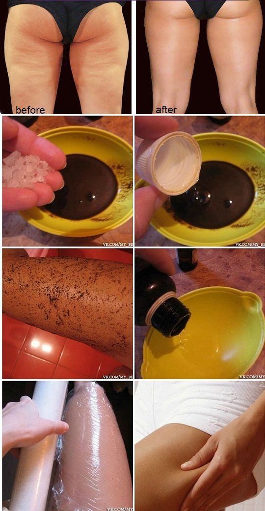 Easy Way to Get Rid of Cellulite…..will have to try this.