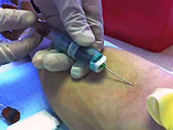 How to preform iv insertion on edematous or obese patients
