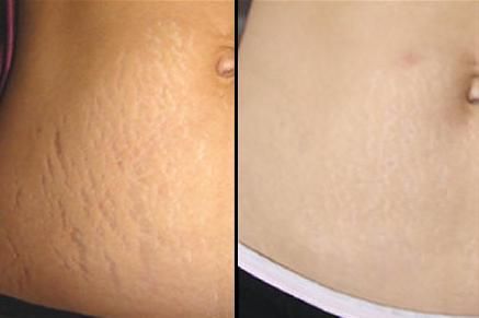 Home Remedies For Stretch Marks That Work Surprisingly Well.. Save for Later