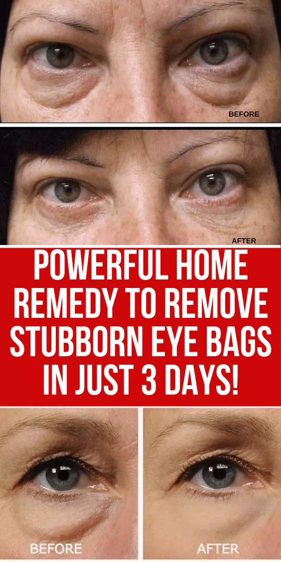 Powerful home remedy to remove stubborn eye bags in just 3 days -   10 skin care Hacks under eyes ideas