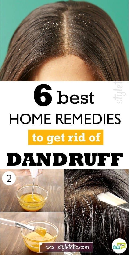 6 Best Home Remedies To Get Rid Of Dandruff For Good -   14 hair Treatment for dandruff ideas