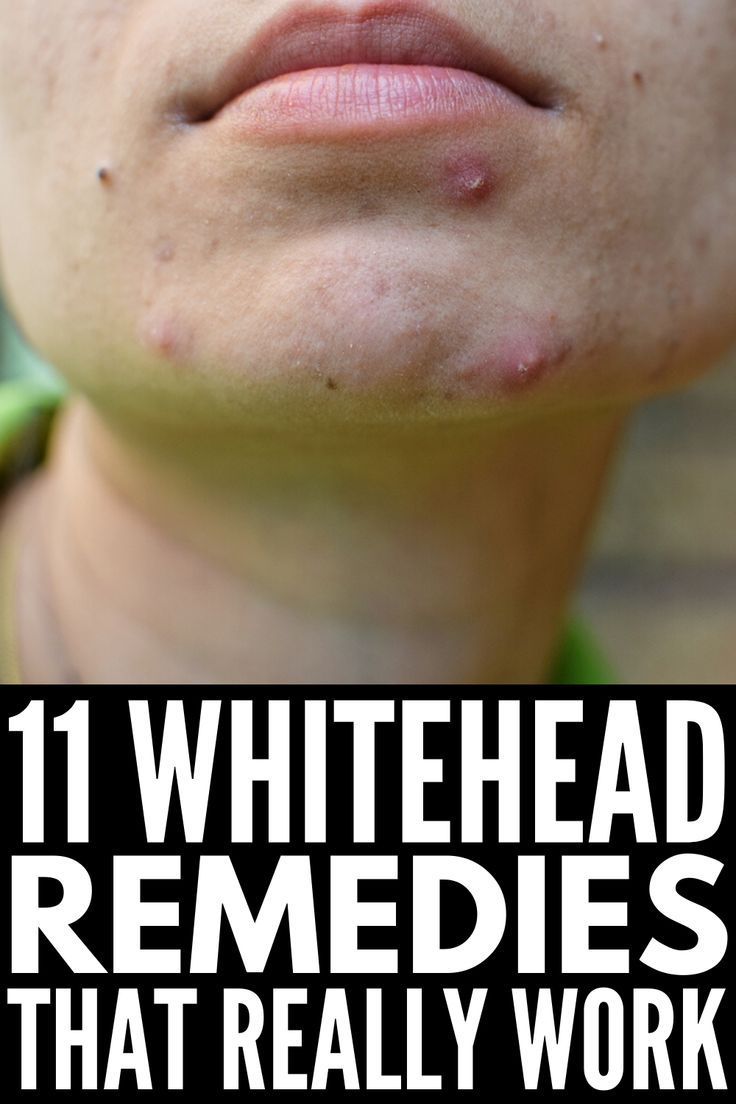 How to Get Rid of Clogged Pores: 11 Remedies & Products We Swear By -   9 skin care Tips whiteheads ideas