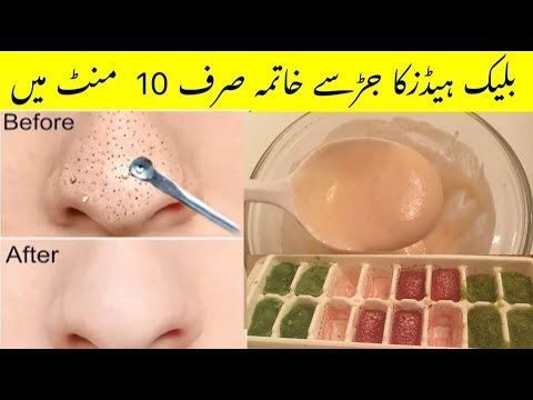 How to Remove Blackheads & whiteheads Home Remedy in Urdu,Hindi//Remove Tone of Blackheads instantly -   9 skin care Tips whiteheads ideas