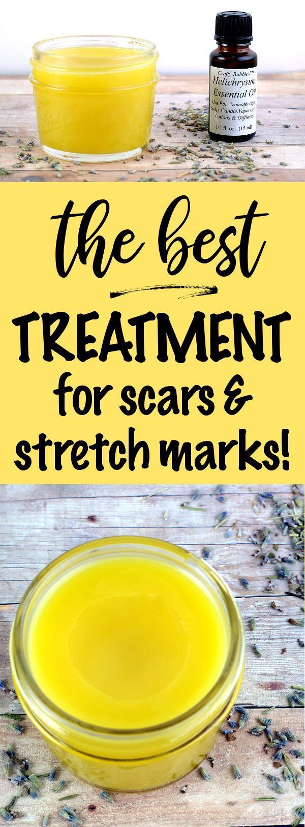 Best Scar and Stretch Mark Treatment You Can Make at Home -   17 skin care Natural it works ideas