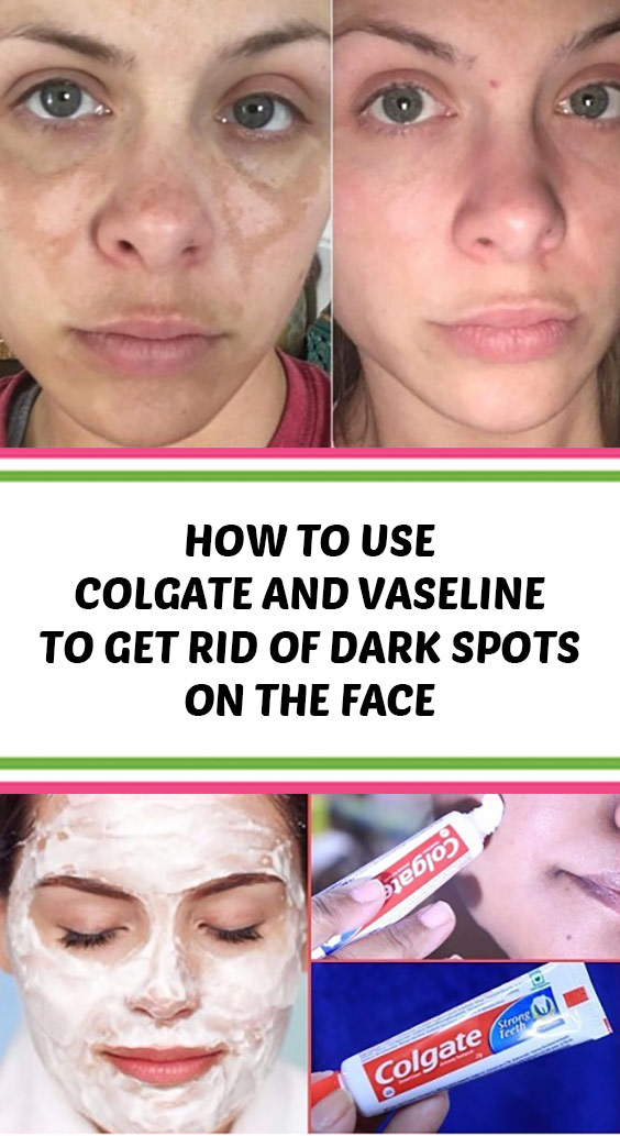 HOW TO USE COLGATE AND VASELINE TO GET RID OF DARK SPOTS ON THE FACE - She Made by Grace -   17 how to get rid of dark spots on face ideas
