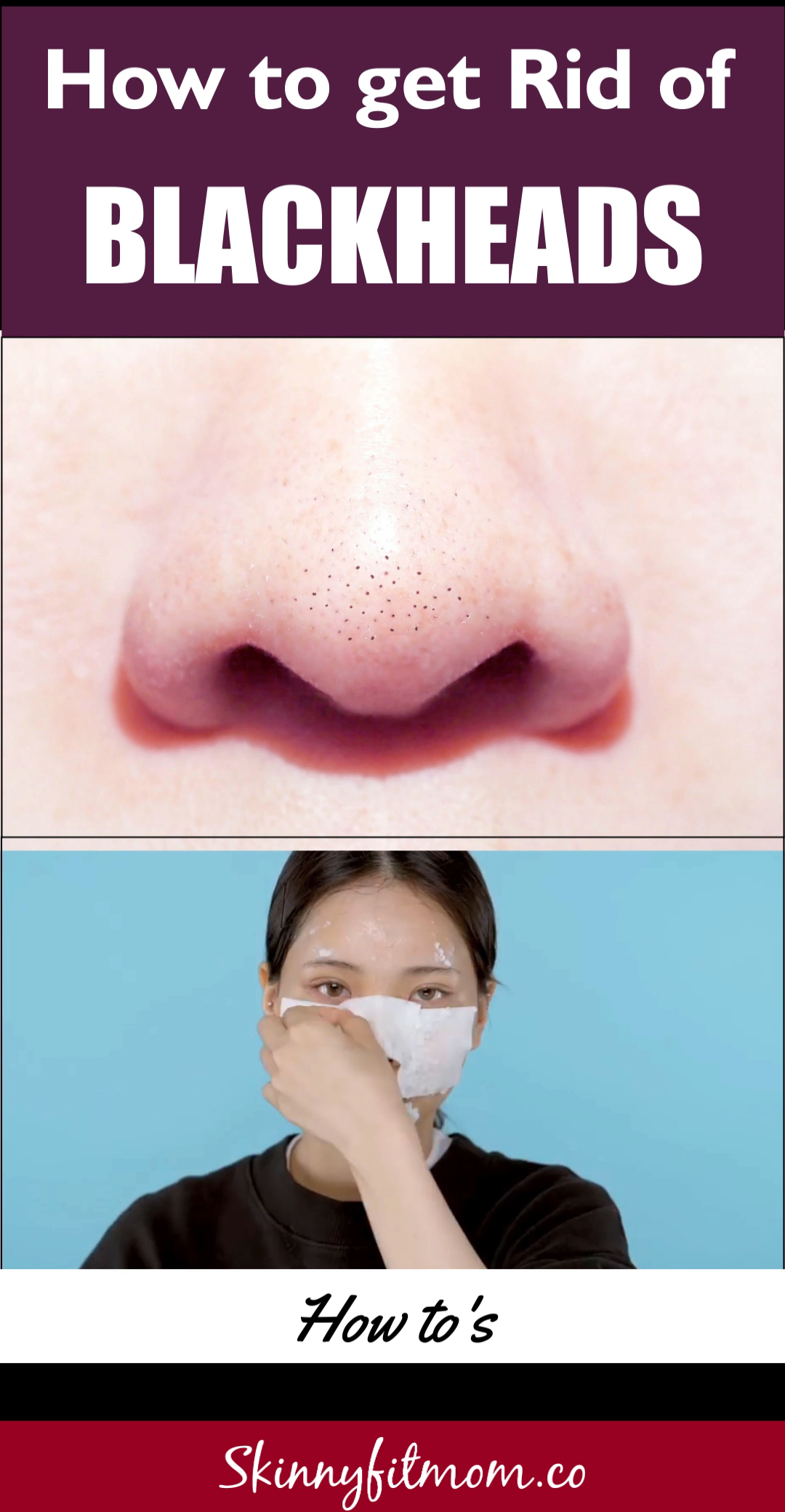 How to Remove Blackheads: The Best AT-Home Treatment -   17 how to get rid of dark spots on face ideas