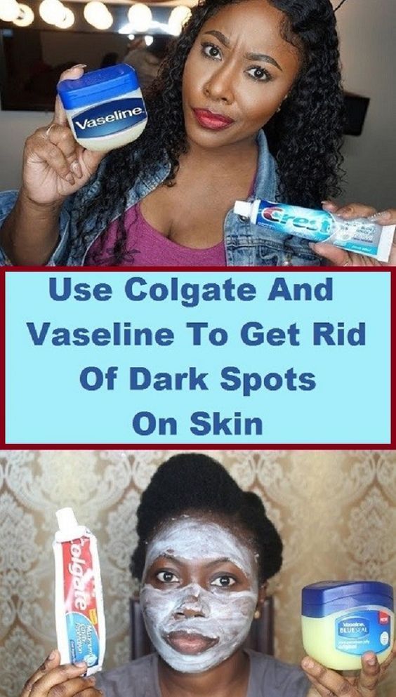 Use Colgate and Vaseline to Get Rid Of Dark Spots On The Face -   17 how to get rid of dark spots on face ideas