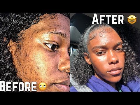 SKIN | How To Get Rid Of Hyperpigmentation (Dark spots) less than a month | FAST!!! -   17 how to get rid of dark spots on face ideas