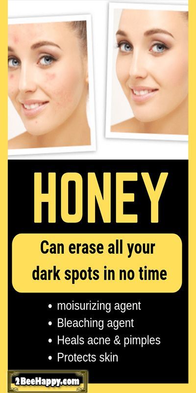 How To Use Organic Honey To Get Rid Of Facial Dark Spots At Home -   17 how to get rid of dark spots on face ideas