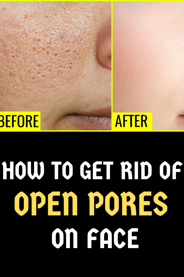 HOW TO GET RID OF OPEN PORES ON FACE -   17 how to get rid of dark spots on face ideas