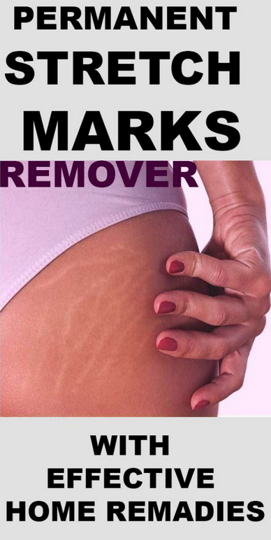 How To Get Rid Of Stretch Marks On Your Bum Thigh And Hips Stretch