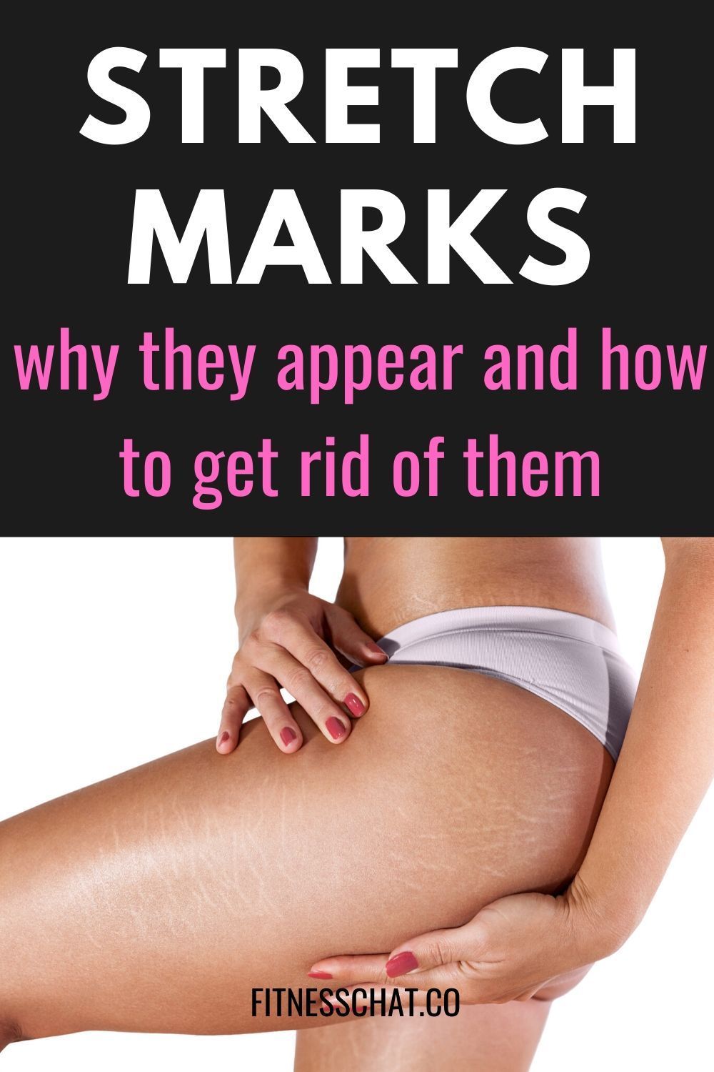 3 Best Ways To Get Rid Of Stretch Marks -   17 how to get rid of stretch marks ideas
