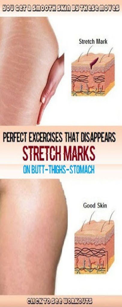 HOW TO GET RID OF STRETCH MARKS on your BUM, THIGH, AND HIPS Stretch Marks Causes -   17 how to get rid of stretch marks ideas