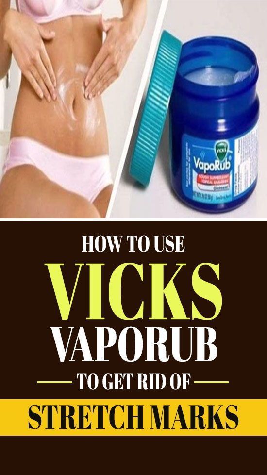 How To Use Vicks VapoRub To Get Rid Of Stretch Marks? -   17 how to get rid of stretch marks ideas