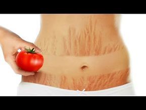 How to Get Rid of Stretch Marks with Tomato and Colgate -   17 how to get rid of stretch marks ideas