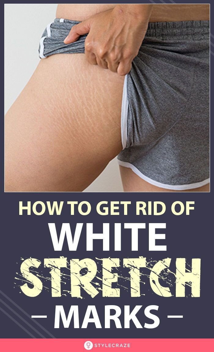 How To Get Rid Of White Stretch Marks? -   17 how to get rid of stretch marks ideas